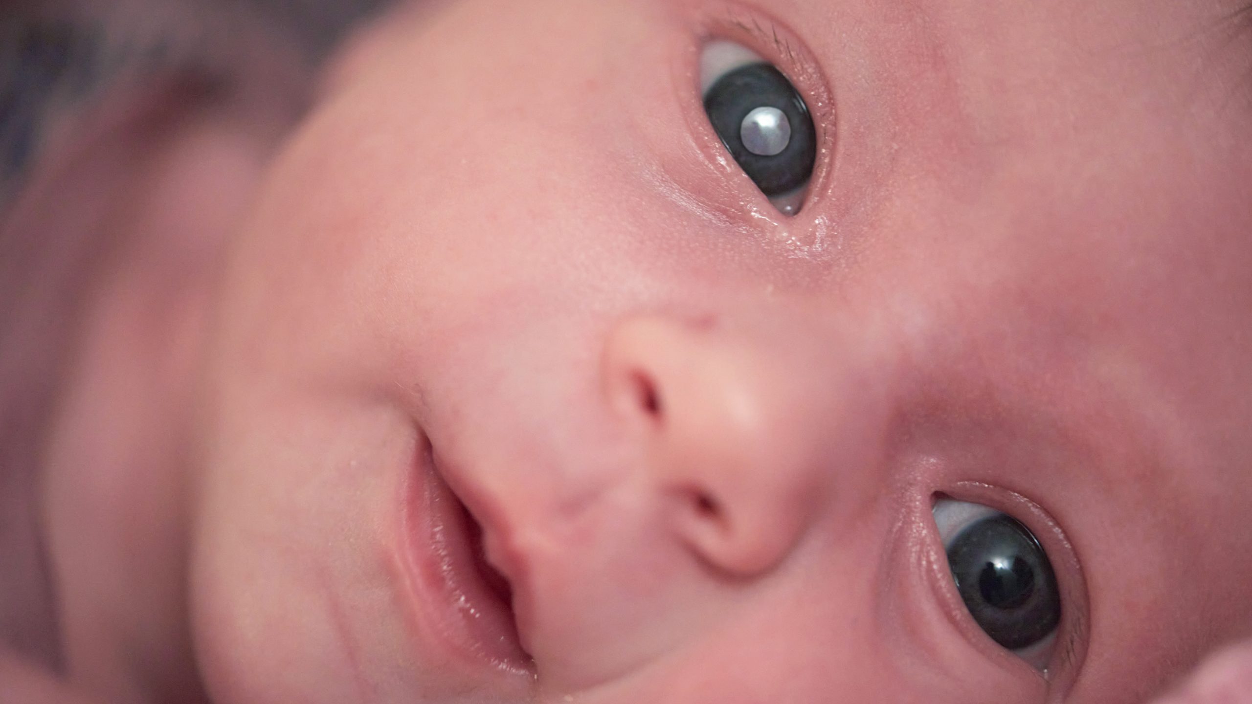 A importância da triagem oftalmológica neonatal na detecção precoce do retinoblastoma